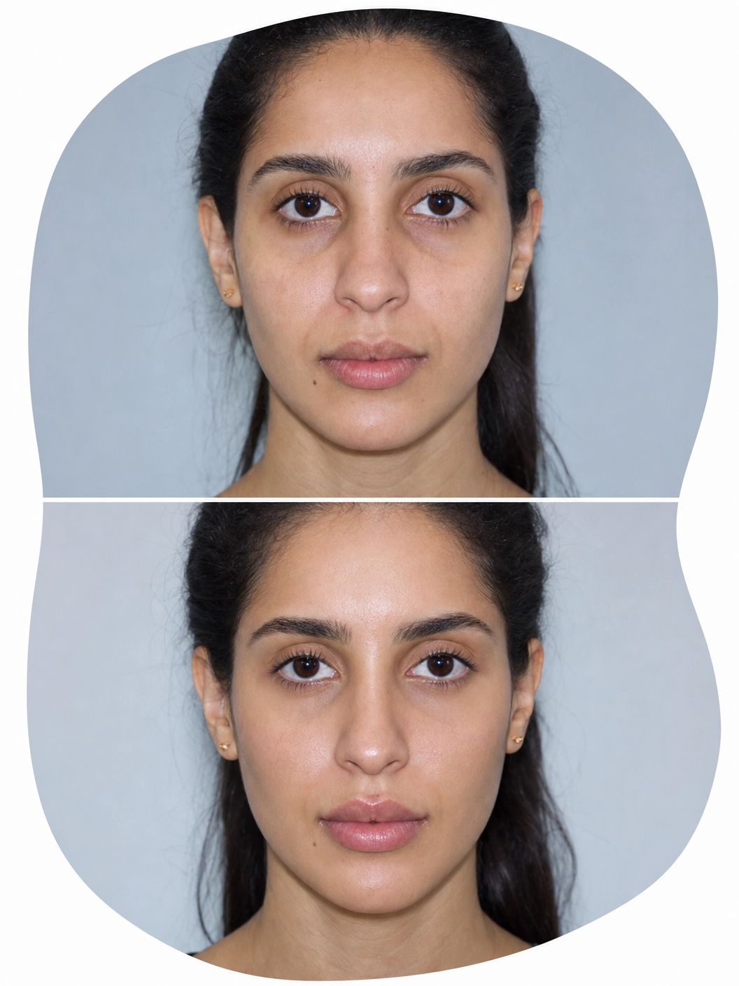 Harmonização Facial