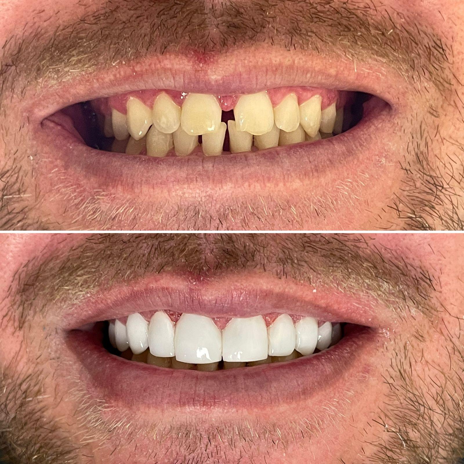 Lentes de Contato Dental